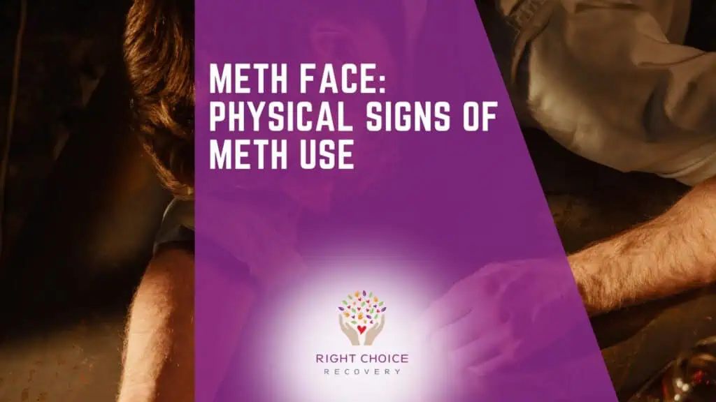 Meth face: physical signs of meth use